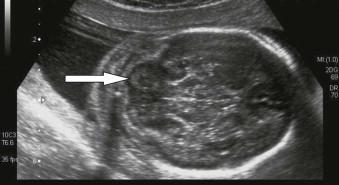 FIGURE 6-9, Axial view of the posterior fossa showing a very heterogeneous looking cerebellum with hypo- and hyperechoic areas (arrows).