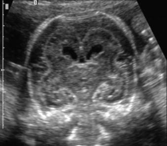 FIGURE 6-10, This coronal view through the fetal brain at the level of the frontal lobes demonstrates lack of gyration of the fissures and sulci and an increase in size of the pericerebral spaces.