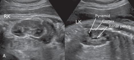 Figure 112.1, Normal fetal kidneys.