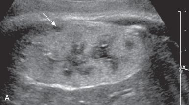 Figure 112.2, Autosomal dominant polycystic kidney disease (ADPKD) and autosomal recessive polycystic kidney disease (ARPKD).