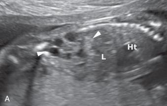 Figure 112.3, Multicystic dysplastic kidney.