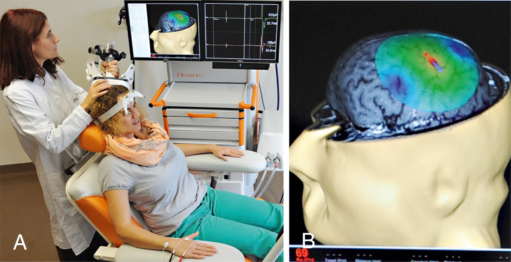 Figure 8.1, E-field navigated transcranial magnetic stimulation (nTMS) motor.