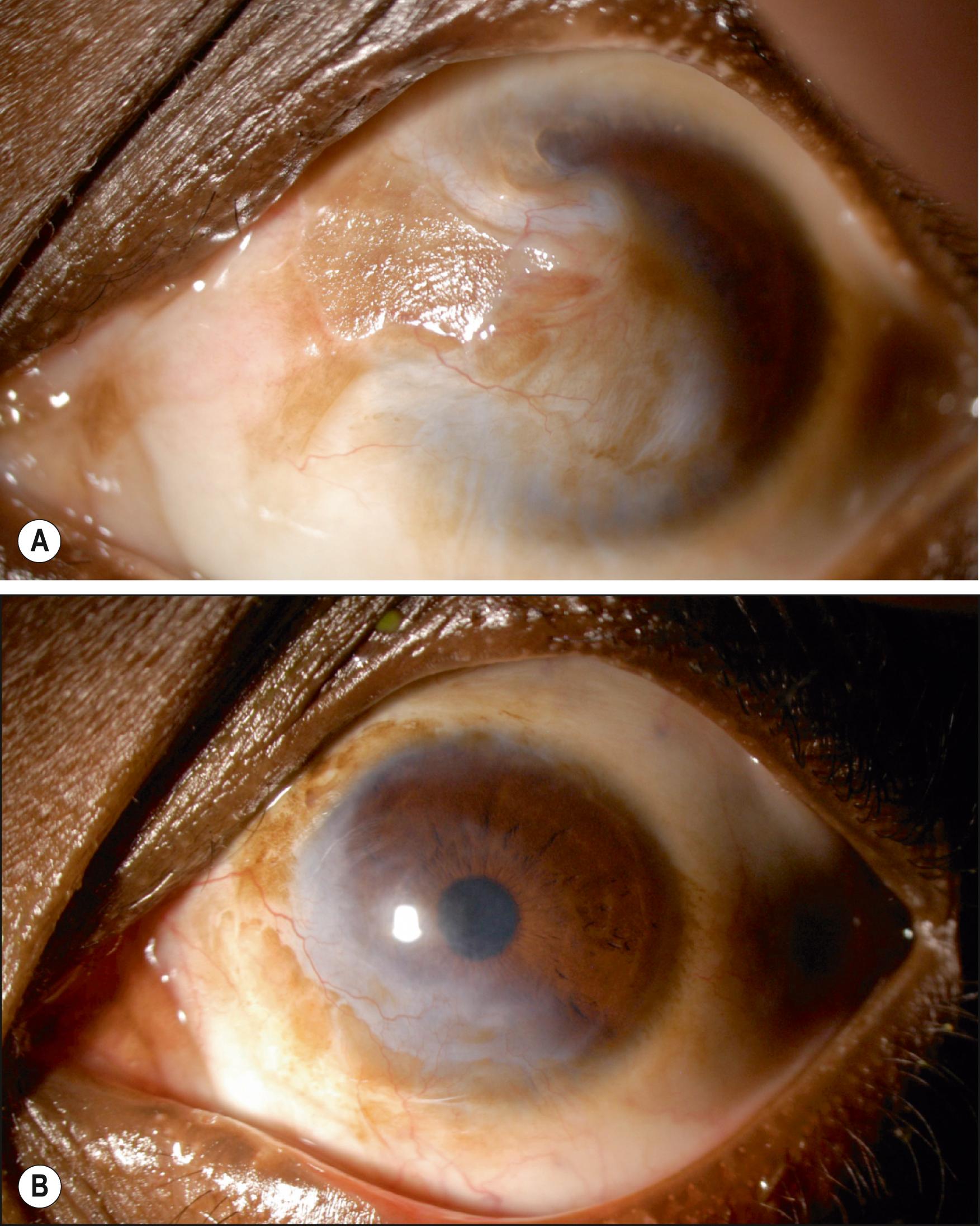 Fig. 110.1, ( A ) A 16-year-old boy after alkali injury to the eye. ( B ) Same eye, 3 months after keratectomy with amniotic membrane transplantation.