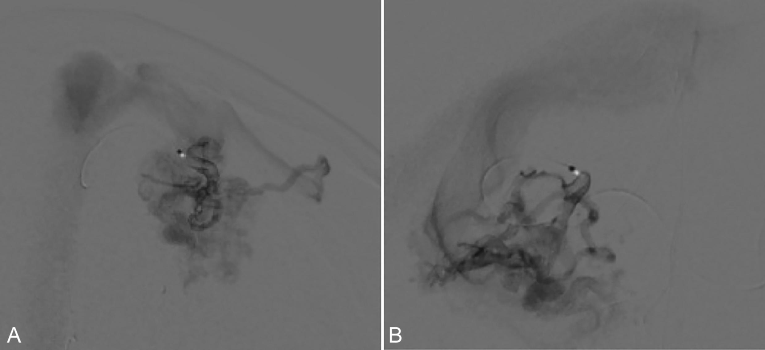 Fig. 29.1, Superselective Wada test. Anteroposterior ( A ) and lateral ( B ) projections of a left parietal AVM microcatheter run demonstrating catheter position for a superselective Wada test.
