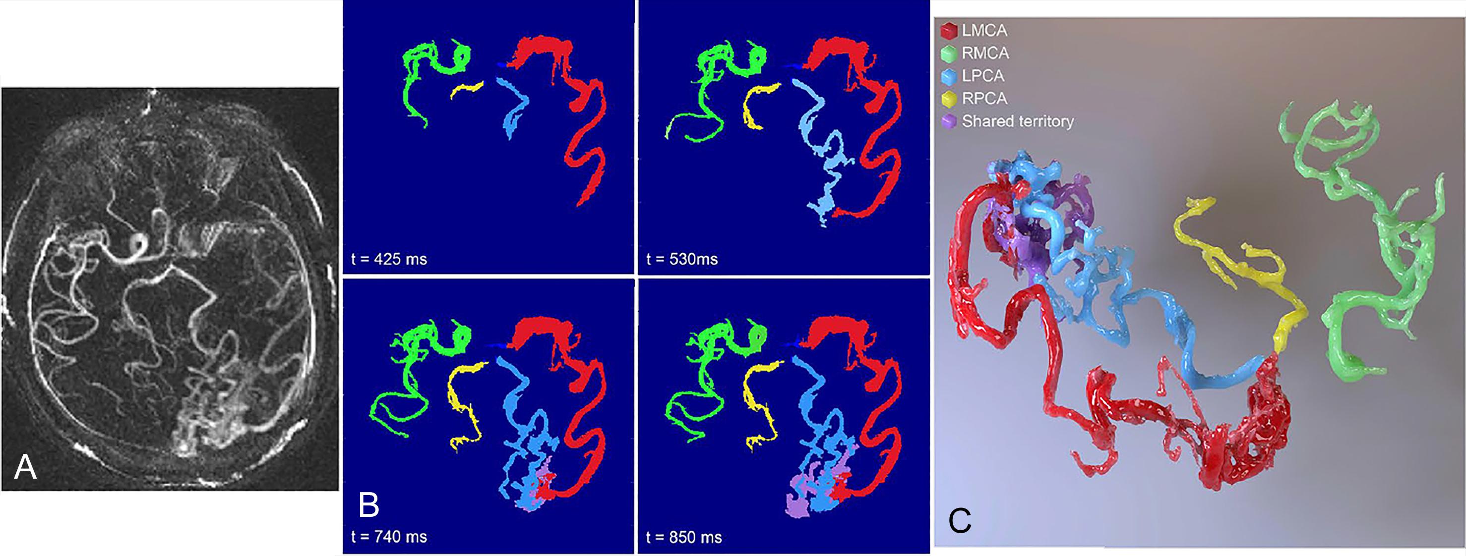 Fig. 29.2, 4D flow MRI. (A) Maximum-intensity projection (MIP) of a dynamic MR angiogram in a representative patient with an AVM. (B) MIP images corresponding to cerebrovascular territory segmentation in the same patient. (C) 3D rendering of vascular territories at the last time point.