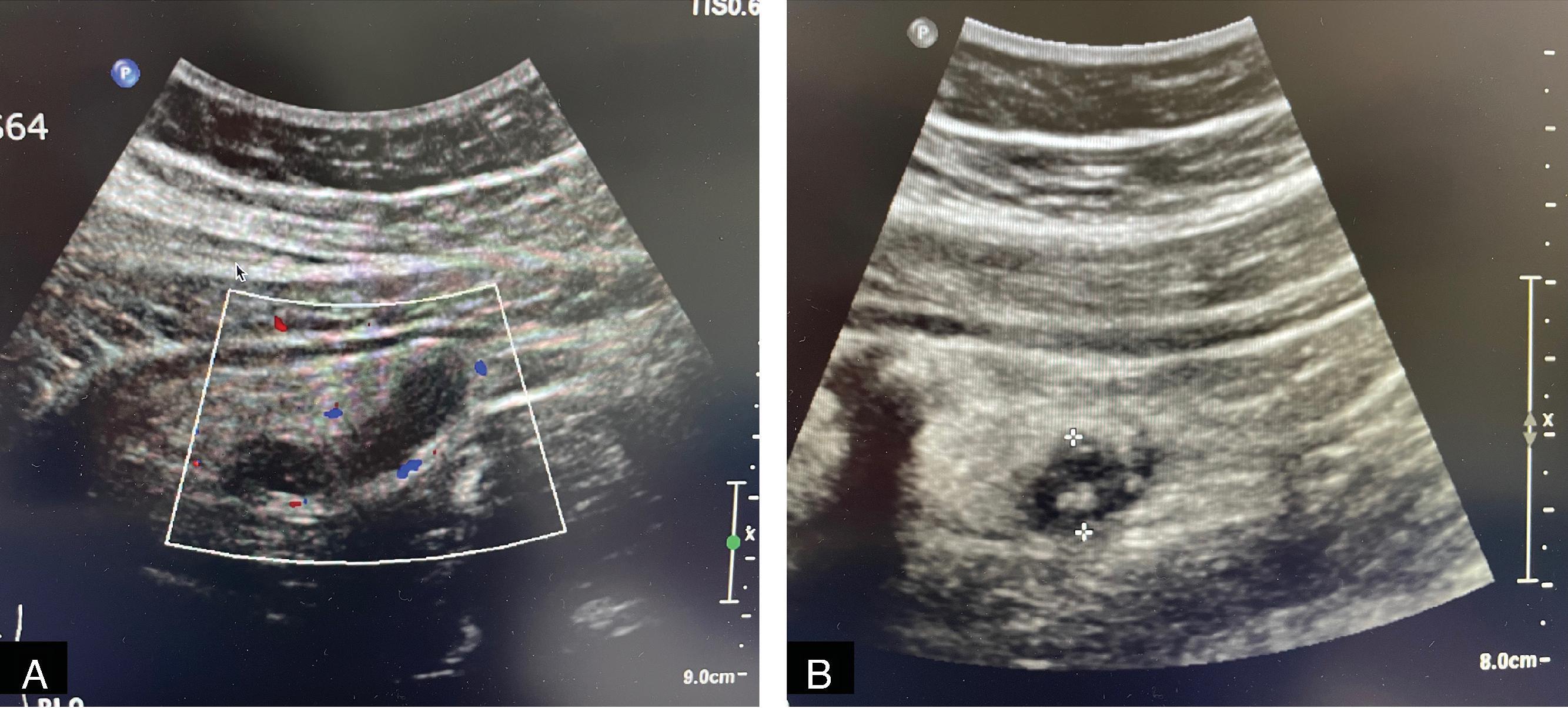 FIG. 1, Selected right lower quadrant ultrasound images in a 10-year-old boy with abdominal pain shows a dilated fluid-filled tubular structure in increased vascularity (A) and an echogenic focus consistent with an appendicolith (B) . These findings are consistent with acute appendicitis.