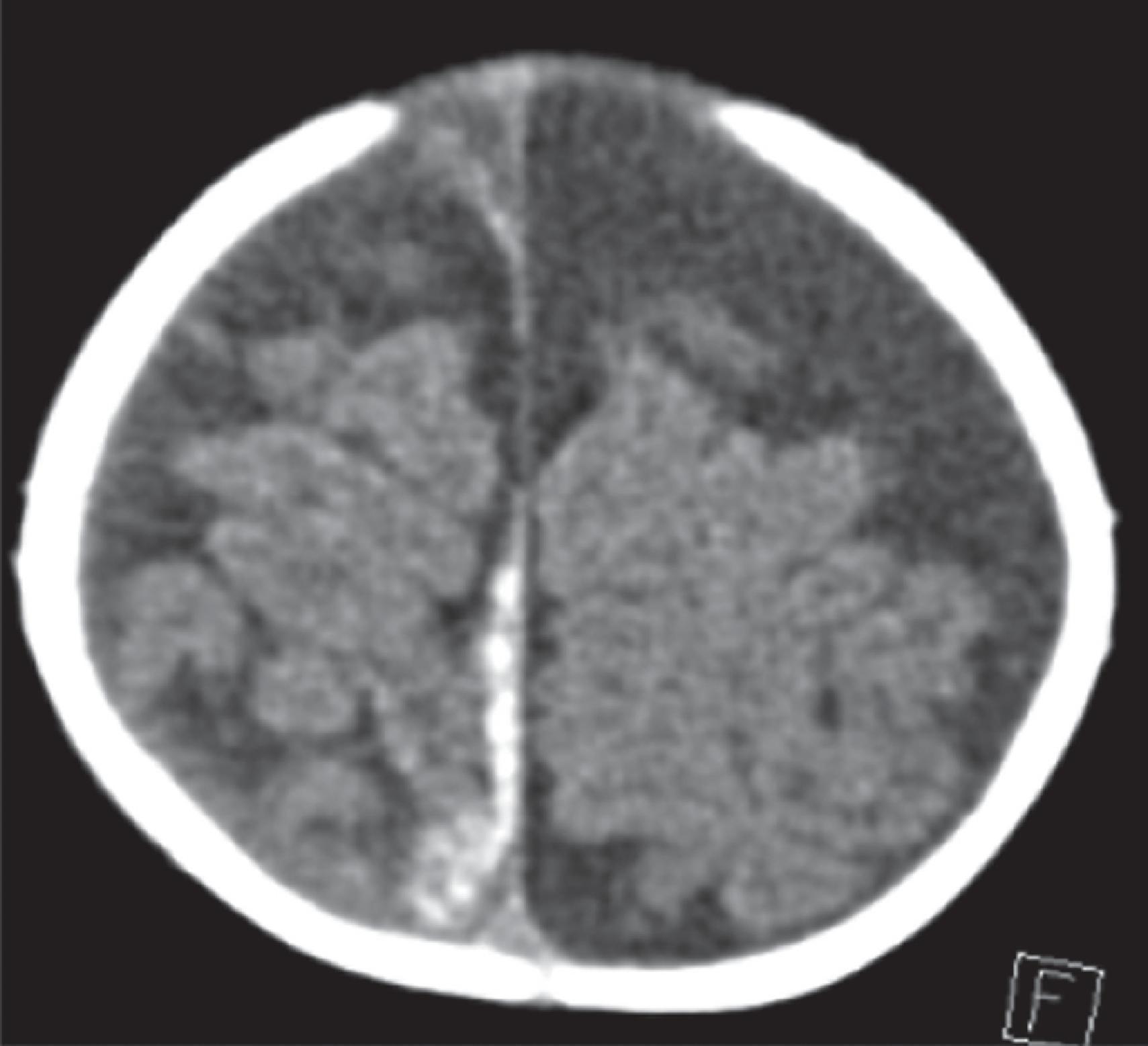 FIG. 2, Transverse head CT image in a 2-month-old boy showing an acute right posterior subdural hematoma secondary to non-accidental trauma.