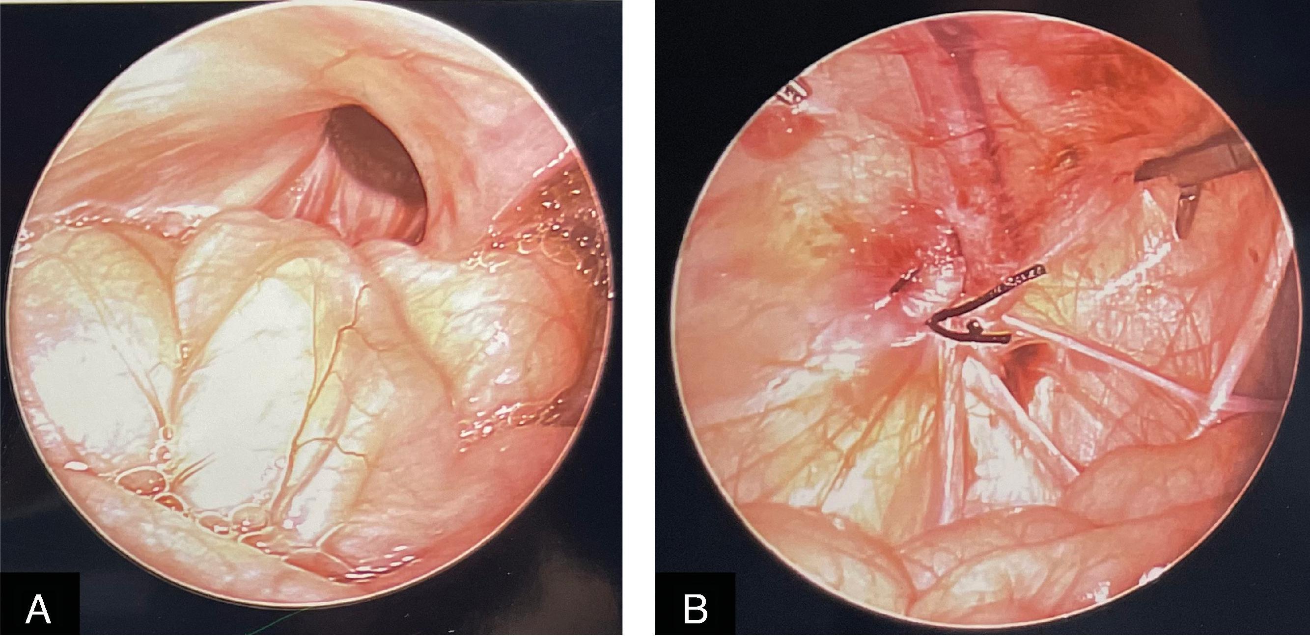 FIG. 3, Intraoperative photographs before (A) and after (B) laparoscopic inguinal hernia repair by ligation of the left internal inguinal ring in an infant.
