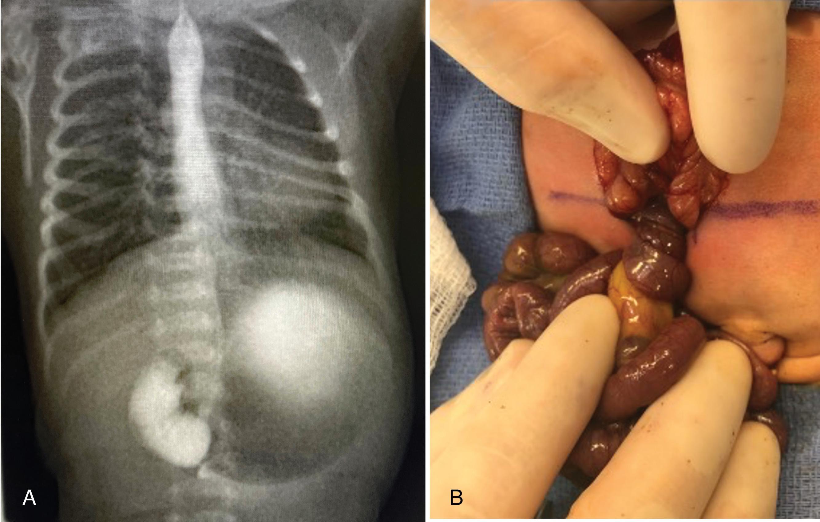 FIG. 4, Bilious emesis in a newborn identified malrotation based on an anteroposterior plain radiograph (A) showing failure of contrast progression past the midline in a dilated duodenum. (B) Intraoperative photograph at emergent laparotomy confirms malrotation with midgut volvulus.