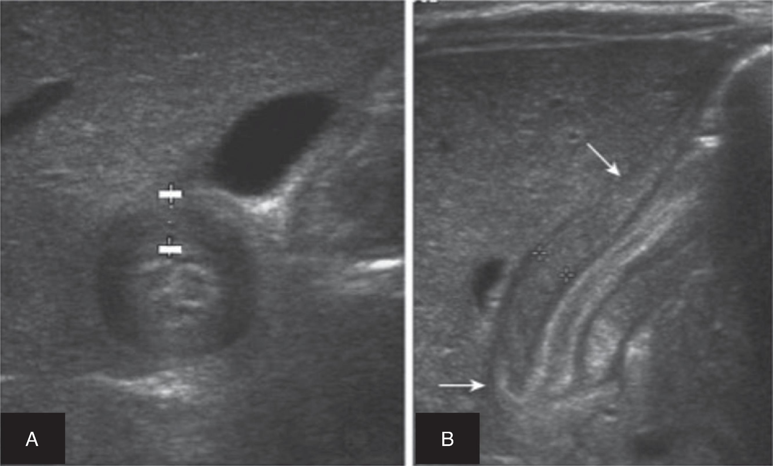 FIG. 5, Ultrasound images of an infant with hypertrophic pyloric stenosis demonstrating transverse view (A) of a thickened pyloric wall to 4 mm and longitudinal view (B ) of an elongated and closed pyloric channel to 17 mm adjacent to a dilated stomach. Arrows delineate the length of the pylorus and point to the outside of the pyloric muscle.