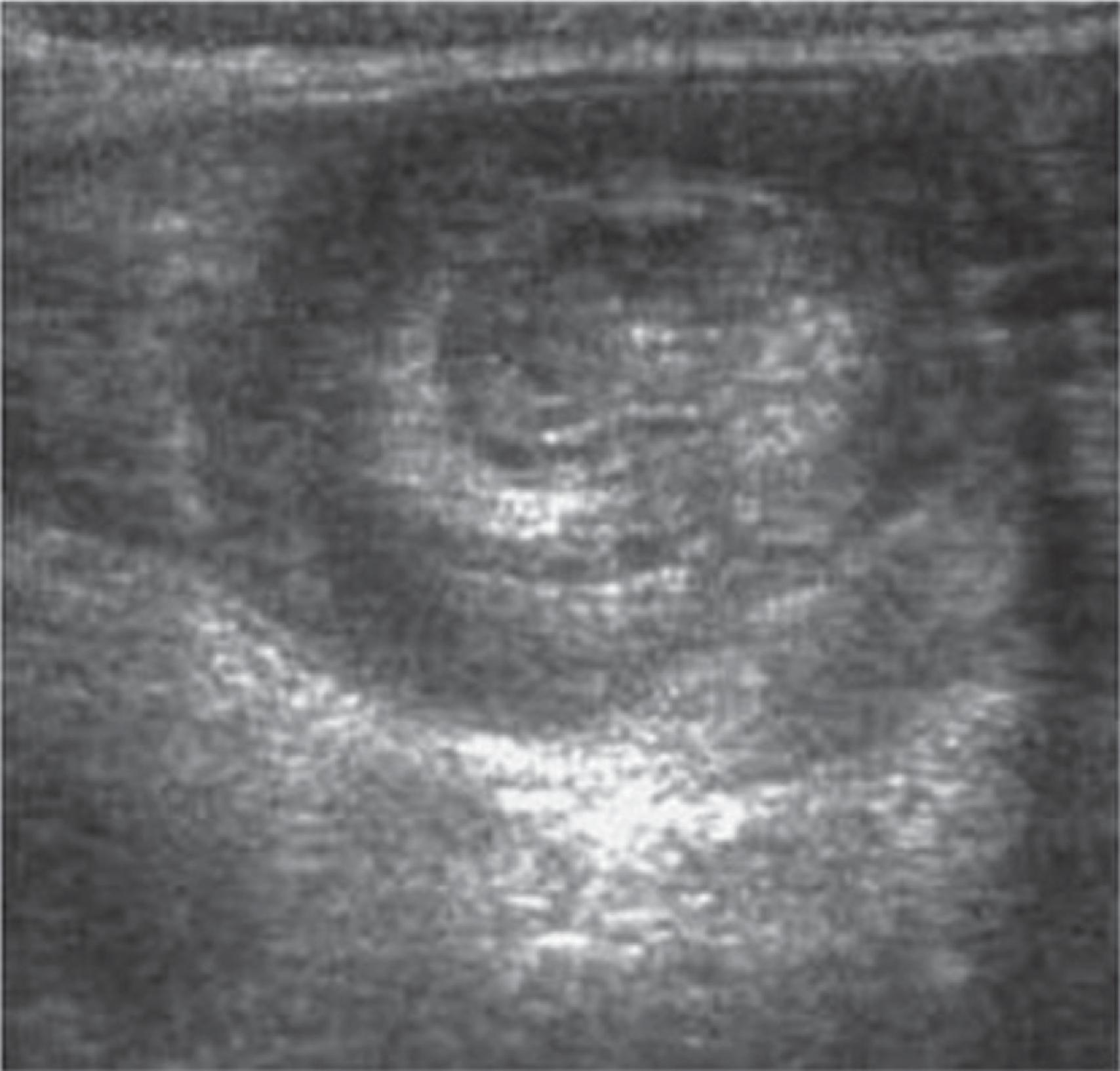 FIG. 6, Abdominal ultrasound image in pediatric patient demonstrating a target sign consistent with ileocolic intussusception.