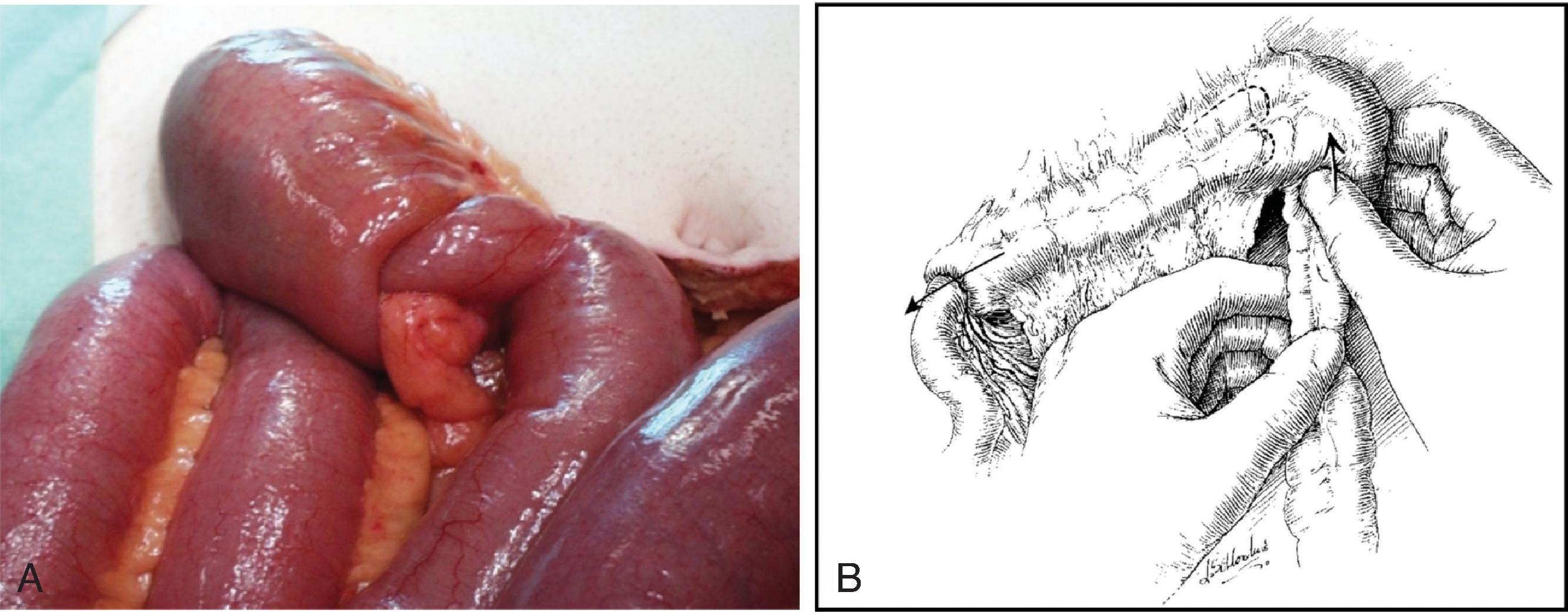 FIG. 7, Ileocolic intussusception as viewed by laparotomy (A) with schematic depiction (B) demonstrating technique used for successful reduction.