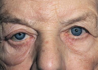 Fig 3.1b, The value of the ‘margin–reflex distance’ – an obvious ptosis but almost equal vertical palpebral apertures due to a retracted right lower lid.