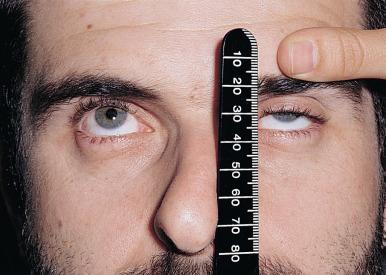 Fig. 3.3a, With the brow fixed, measure the upper lid excursion between upgaze …