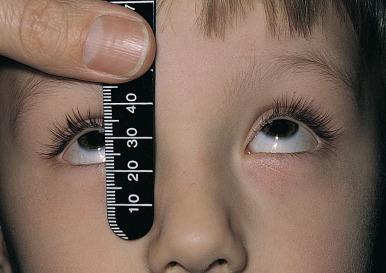 Fig. 3.3c, In children, fix the brow and hold the rule with the same hand …