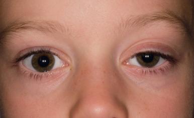 Fig. 3.3e, Left congenital ptosis.