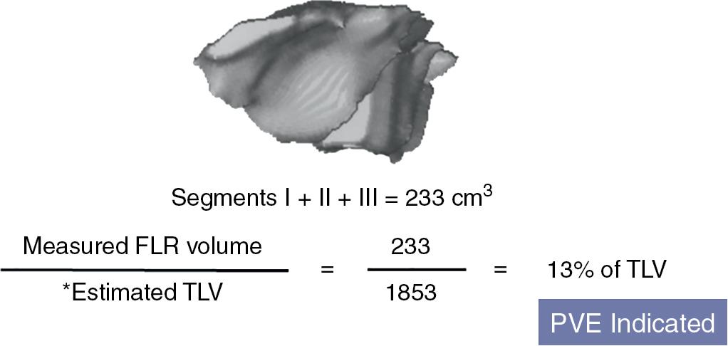 FIGURE 102C.4, Measurement of standardized future liver remnant (sFLR) volume to estimate the risk of extended hepatectomy.