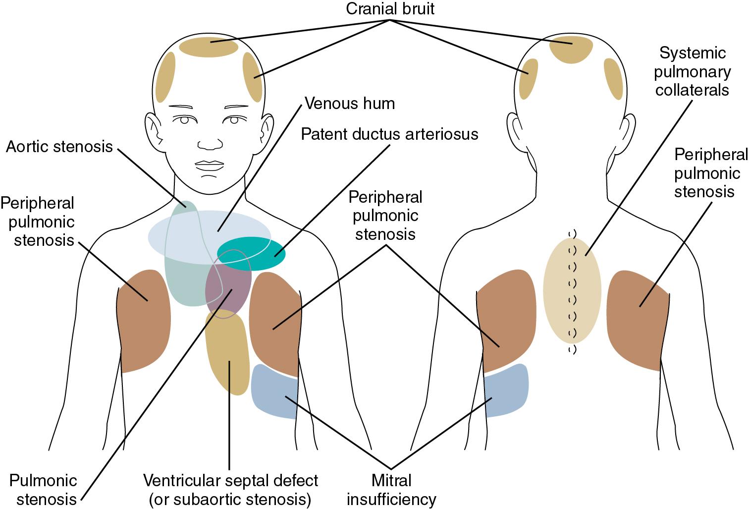 Fig. 16.4, Sites for Auscultation Where Murmurs Are Heard Best.