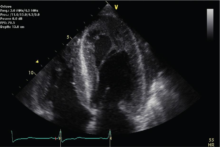 Fig. 4.5, Increased LV wall thickness and a characteristic “speckled” pattern in diastole in an 83-year-old with severe AS and confirmed cardiac amyloidosis. AS , Aortic stenosis; LV , left ventricular.