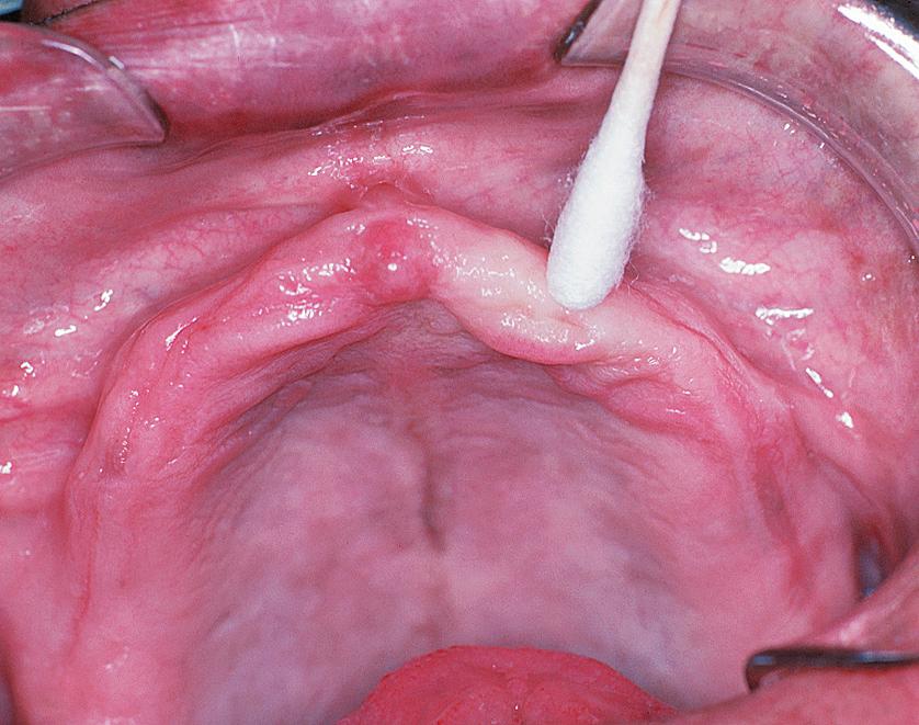 Fig. 13.5, Palpation reveals hypermobile tissue that will not provide an adequate base in the denture-bearing area.