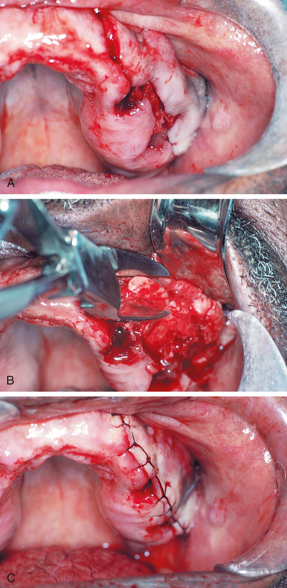 Fig. 13.11, Removal of buccal exostosis. (A) Gross irregularities of the buccal aspect of the alveolar ridge. After tooth removal, incision is completed over the crest of the alveolar ridge. (Vertical-releasing incision in the cuspid area is demonstrated.) (B) Exposure and removal of buccal exostosis with a rongeur. (C) Soft tissue closure using a continuous suture technique.