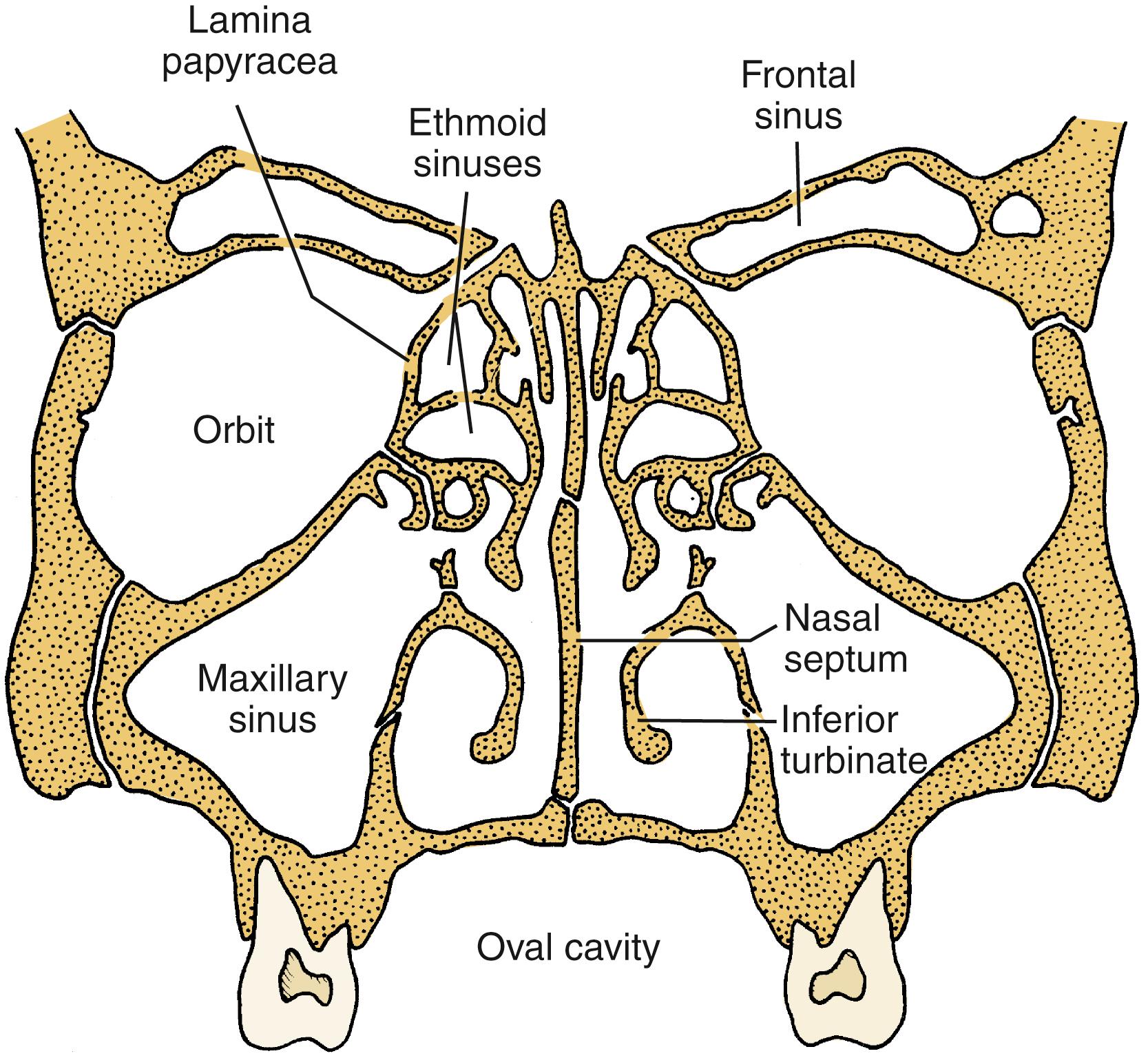 FIGURE 84.3, The relationship between the eye and the paranasal sinuses is shown schematically. The roof of the orbit, the medial wall, and the floor are shared by the frontal, ethmoid, and maxillary sinuses, respectively.