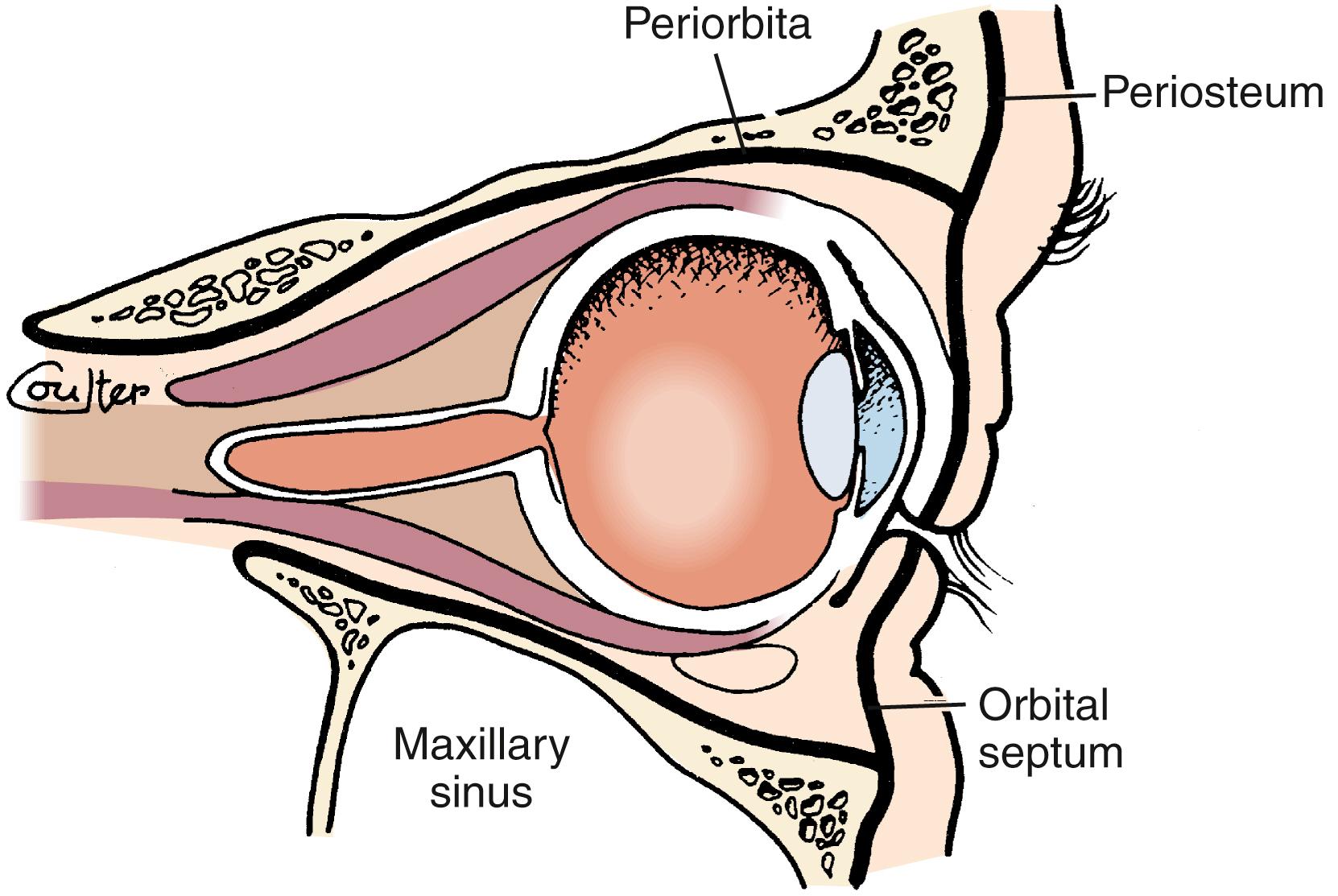 FIGURE 84.4, The orbital septum is a connective tissue extension of the periosteum that is reflected into the upper and lower lid.