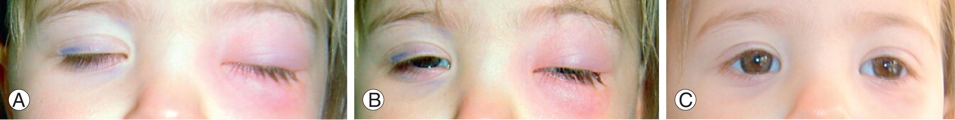 Fig. 13.3, Preseptal/orbital cellulitis treated successfully with intravenous antibiotics. (A) At presentation with swollen lids and possibly mild proptosis. Patient was admitted under pediatricians, ophthalmologist, and ENT. She was treated immediately with intravenous antibiotics. No imaging was performed. (B) Responding to antibiotics within 12 hours. (C) Fully resolved at 4 days.