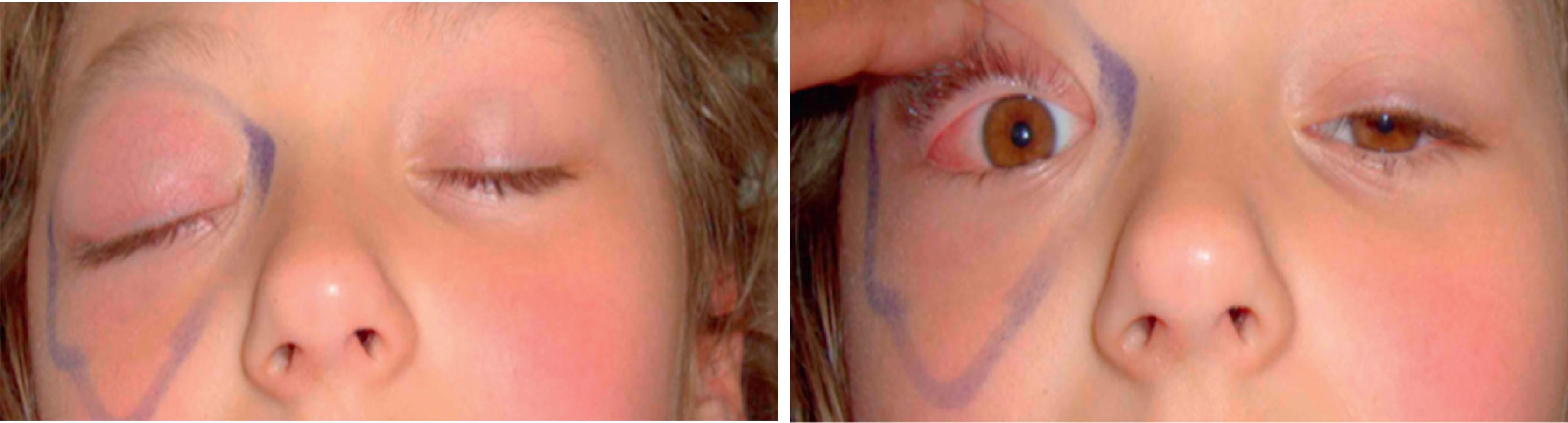 Fig. 13.6, It is useful to mark the extent of cellulitis for monitoring purposes. This 10-year-old girl had proptosis and responded to intravenous antibiotics.