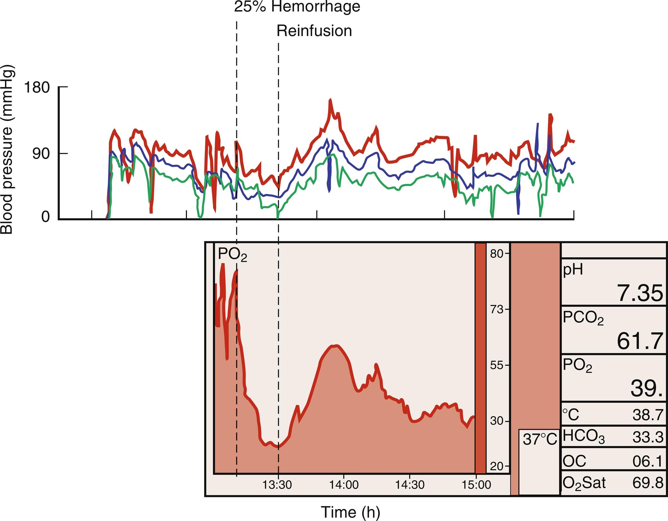 Fig. 17.1, An example of renal medullary hypoxia and the adverse effects of hypovolemic shock on medullary perfusion. In a pig model, a renal medullary oxygen sensor demonstrates medullary hypoxemia at baseline. Blood pressure changes are represented during experimental hemorrhage (25% blood volume). Exaggerated medullary hypoxia develops during the period of hypoperfusion. Note the close correlation between perfusion pressure and renal medullary oxygen levels.