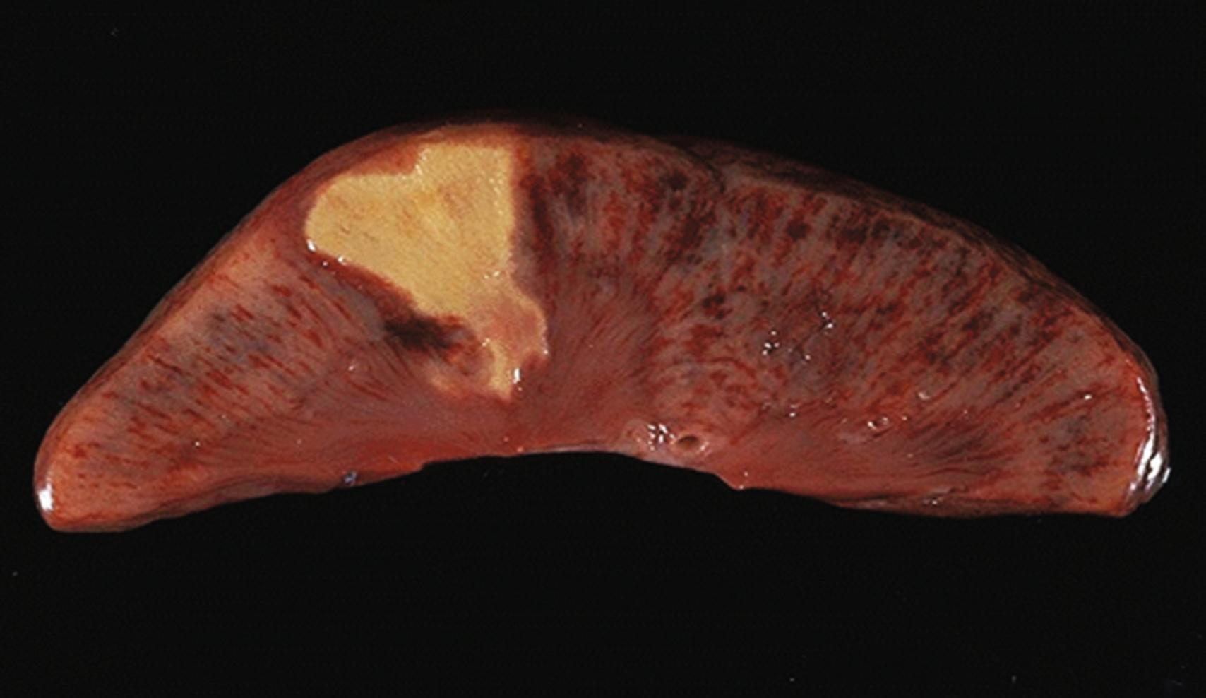 Fig. 17.3, A gross kidney specimen demonstrates the wedge-shaped pattern typical of a renal infarct. The organization of the renal vasculature means that embolic arterial obstruction is poorly compensated for by collateral flow.