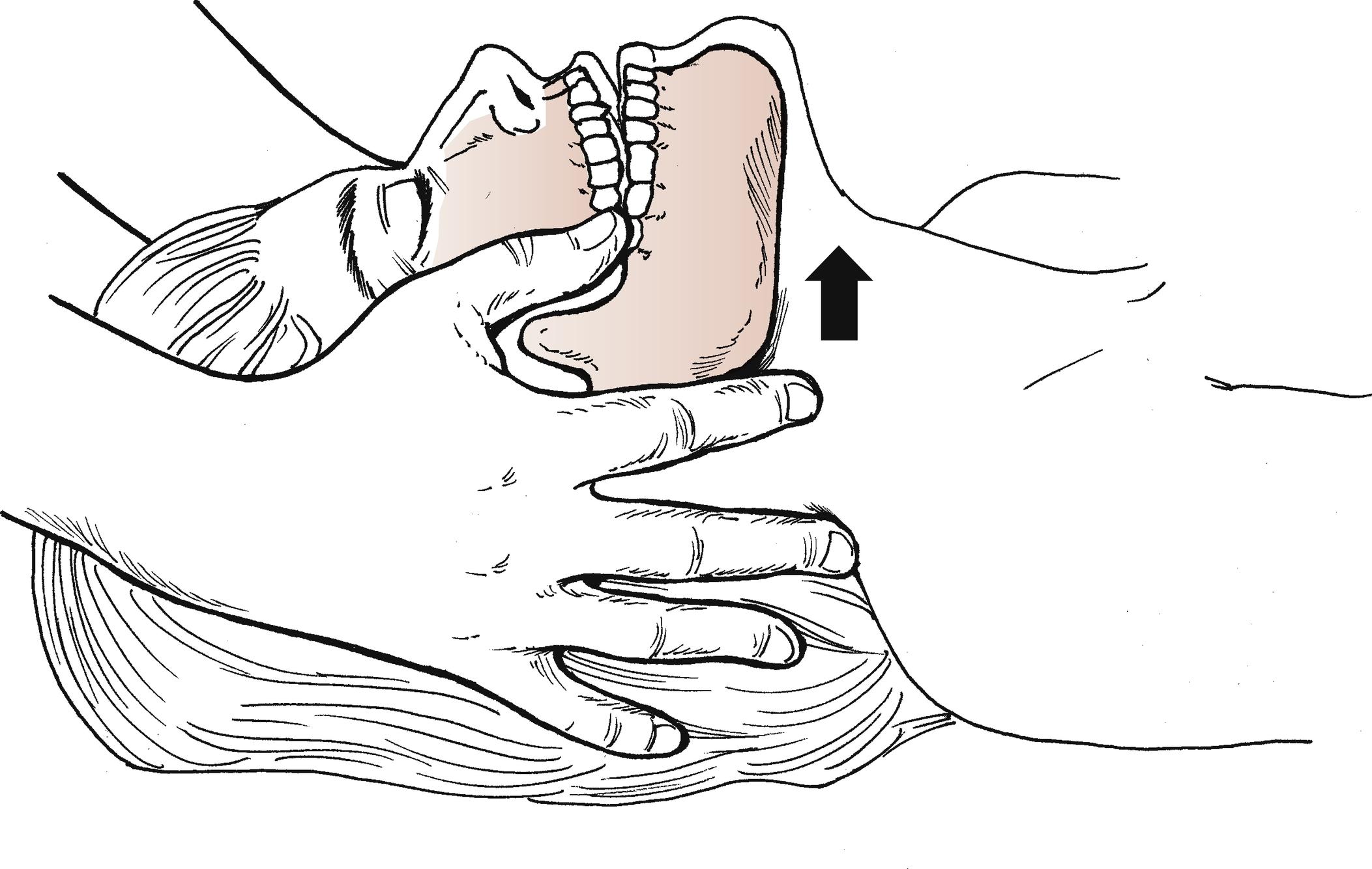 Fig. 23.1, The jaw thrust maneuver using the first two or three fingers of each hand to lift the mandible forward and outward (arrow) to establish an airway. The head and neck are immobilized in a neutral position to prevent injury to the spinal cord in patients with suspected cervical spine injuries.