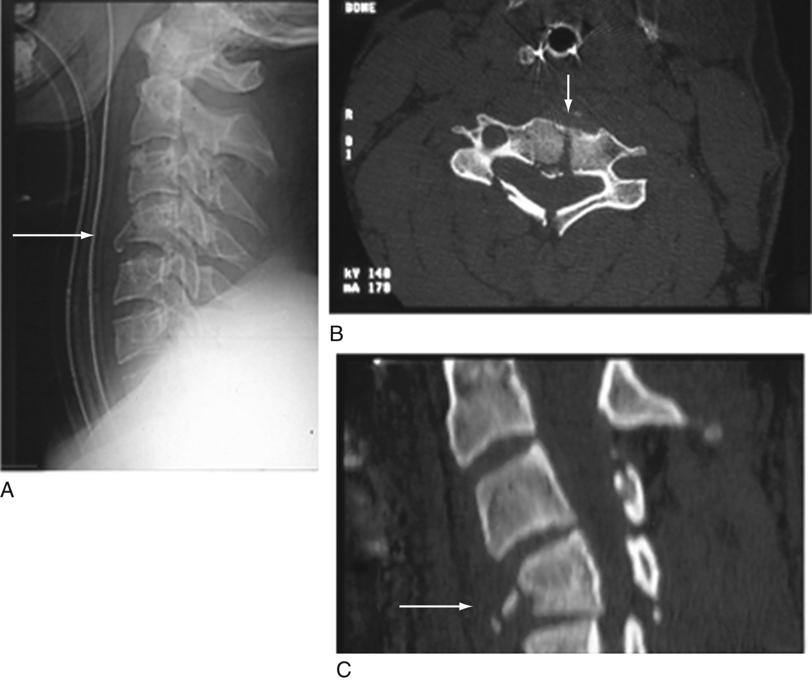 Fig. 23.3, Traumatic C4 vertebral body fracture demonstrating the fracture through the vertebral body (arrows) . (A) Lateral plain film, (B) axial computed tomography (CT) scan, and (C) sagittal CT scan.