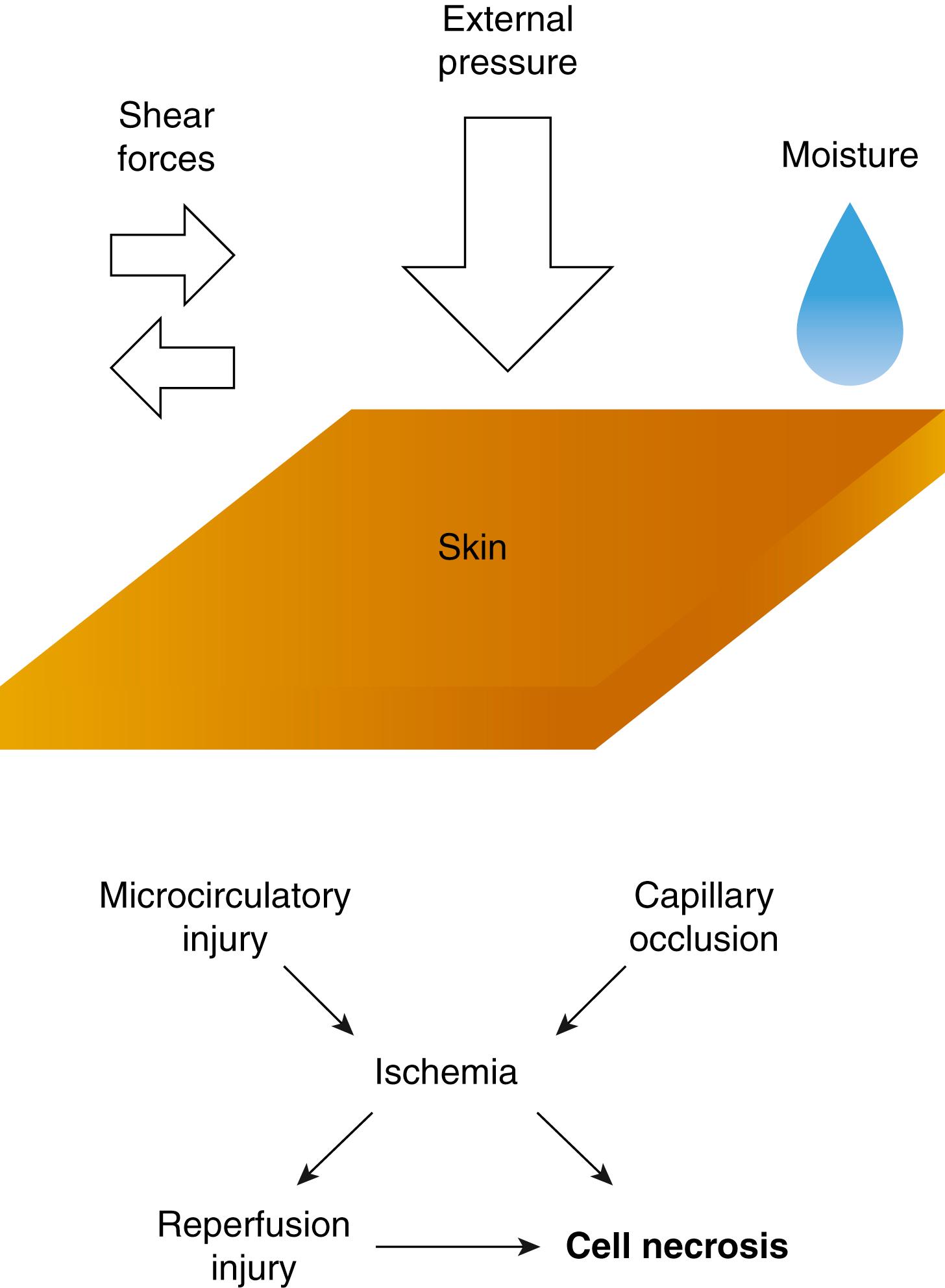 Fig. 42.1, Pressure injury pathogenesis.