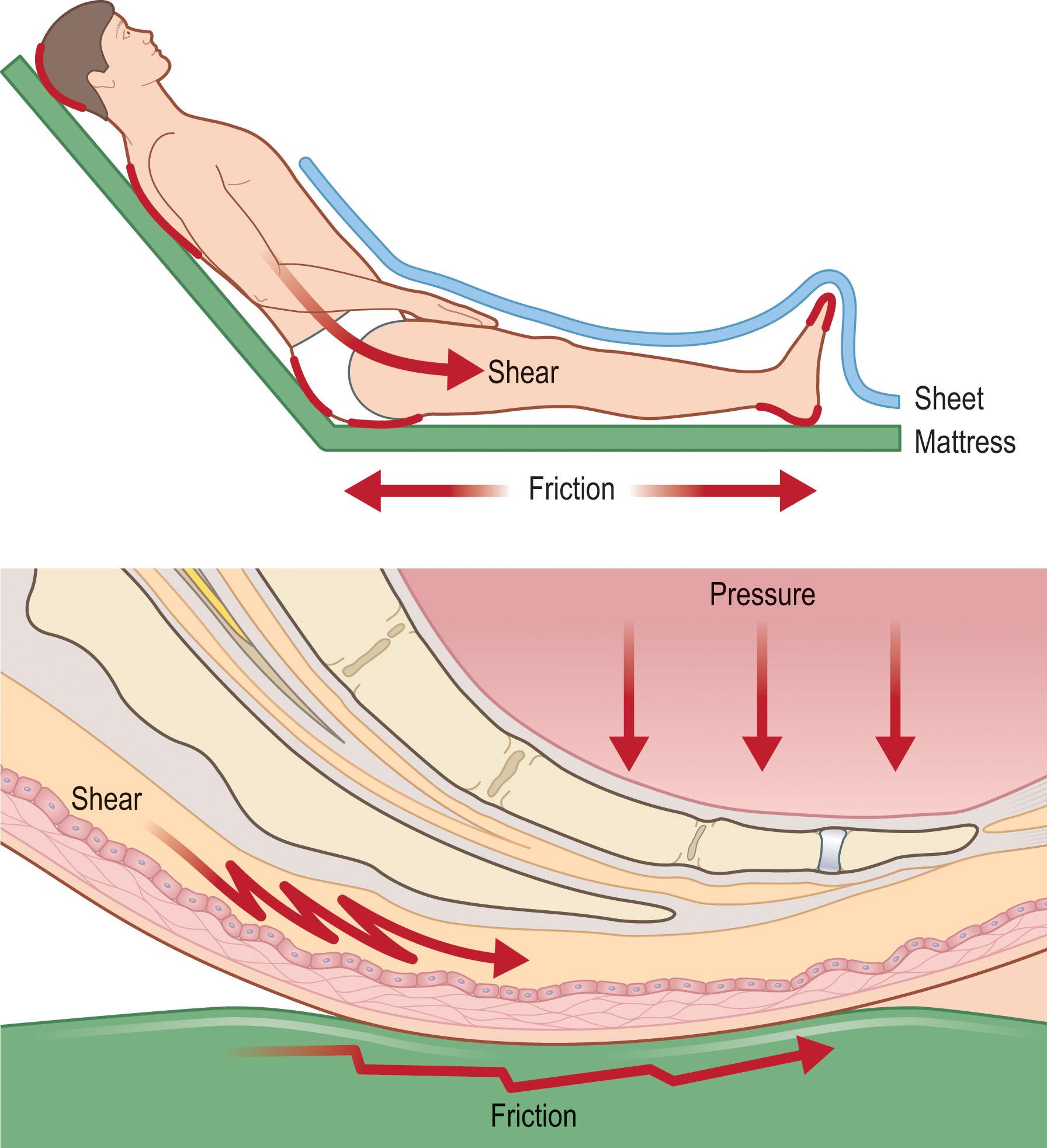 Figure 16.3, Pressure, shear, and friction are related but distinct forces which contribute to pressure sore development.