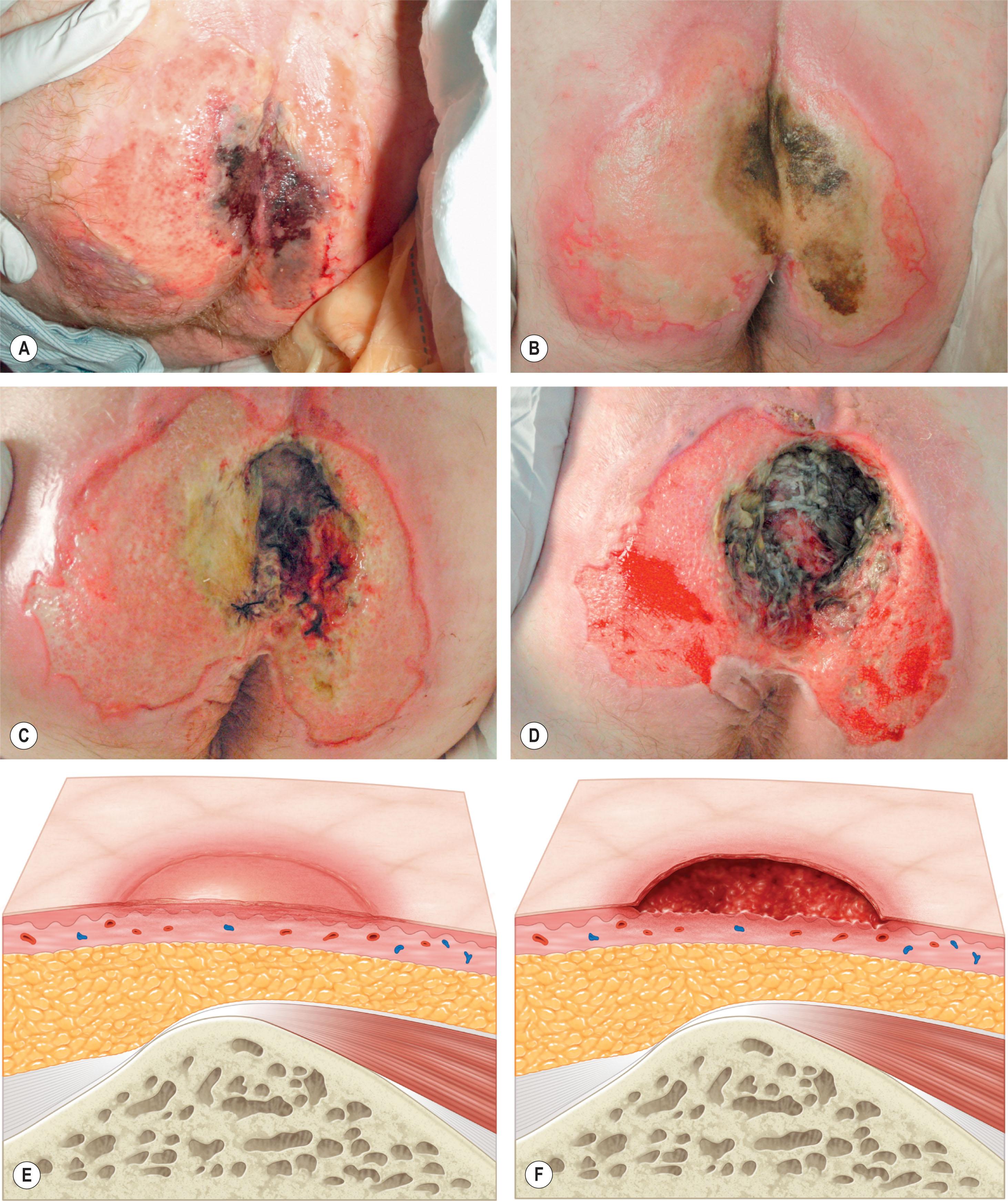Figure 16.4, The National Pressure Ulcer Advisory Panel staging system. (A,E) Stage I: Intact skin with nonblanchable redness of a localized area usually over a bony prominence. Darkly pigmented skin may not have visible blanching; its color may differ from the surrounding area. (B,F) Stage II: Partial-thickness loss of dermis presenting as a shallow open ulcer with a red pink wound bed, without slough. May also present as an intact or open/ruptured serum-filled blister. This should not be used to describe skin tears, tape burns, perineal dermatitis, maceration, or excoriation. (C,G) Stage III: Full-thickness tissue loss. Subcutaneous fat may be visible, but bone, tendon, or muscle is not exposed. Slough may be present but does not obscure the depth of tissue loss. May include undermining and tunneling. (D,H) Stage IV: Full-thickness tissue loss with exposed bone, tendon, or muscle. Exposed bone is sufficient but not necessary to define a stage IV pressure sore. Slough or eschar may be present on some parts of the wound bed. Often includes undermining or tunneling. May extend into muscle and/or supporting structures (e.g., fascia, tendon, or joint capsule), making osteomyelitis possible. Bone/tendon is visible or directly palpable. (I) Suspected deep-tissue injury: Purple or maroon localized area of discolored intact skin or blood-filled blister due to damage of underlying soft tissue from pressure and/or shear. The area may be preceded by tissue that is painful, firm, mushy, boggy, warmer, or cooler as compared to adjacent tissue. The wound may evolve and become covered by thin eschar. Evolution may be rapid, exposing additional layers of tissue even with optimal treatment. (J) Unstageable: Full-thickness tissue loss in which the base of the ulcer is covered by slough (yellow, tan, gray, green, or brown) and/or eschar (tan, brown, or black) in the wound bed. Until the base of the wound is exposed, the true depth, and therefore stage, cannot be determined.
