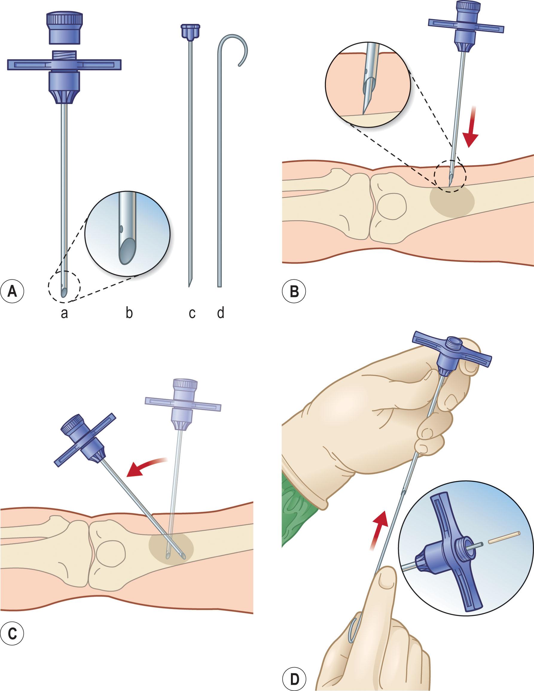 Figure 16.6, (A) The Jamshidi bone biopsy needle, cannula, and screw-on cap (a), tapered point (b), pointed stylet to advance cannula through soft tissues (c), and probe to expel specimen from cannula (d). (B) With the stylet locked in place, the cannula is advanced through the soft tissue until bone is reached. The inset is a close-up view showing stylet against bone cortex. (C) The stylet is removed, and the bone cortex is penetrated with the cannula. The cannula is withdrawn, and the procedure repeated with redirection of the instrument to obtain multiple core samples. (D) The probe is then inserted retrograde into the tip of the cannula to expel the specimen through the base ( inset ).