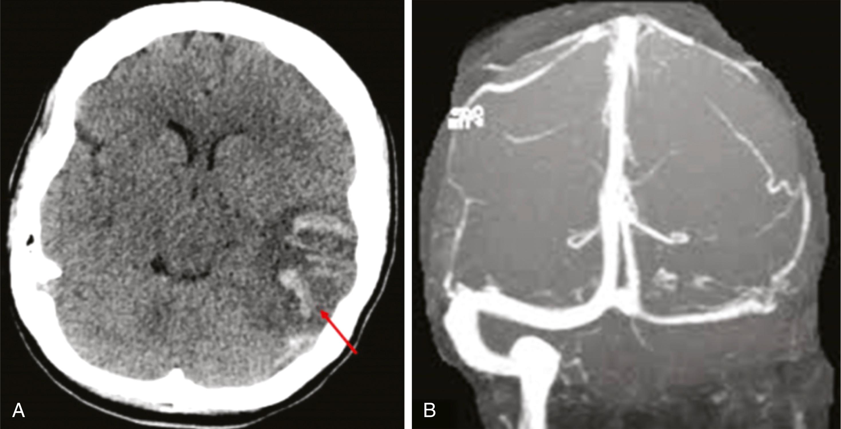 FIGURE 45.2, Cerebral venous thrombosis.