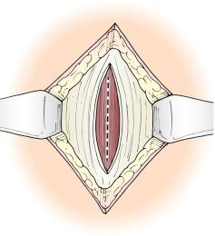 FIGURE 90-2, Exposure and incision of the anterior rectus sheath.