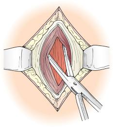 FIGURE 90-3, Spreading of the rectus fibers to reveal the posterior sheath.