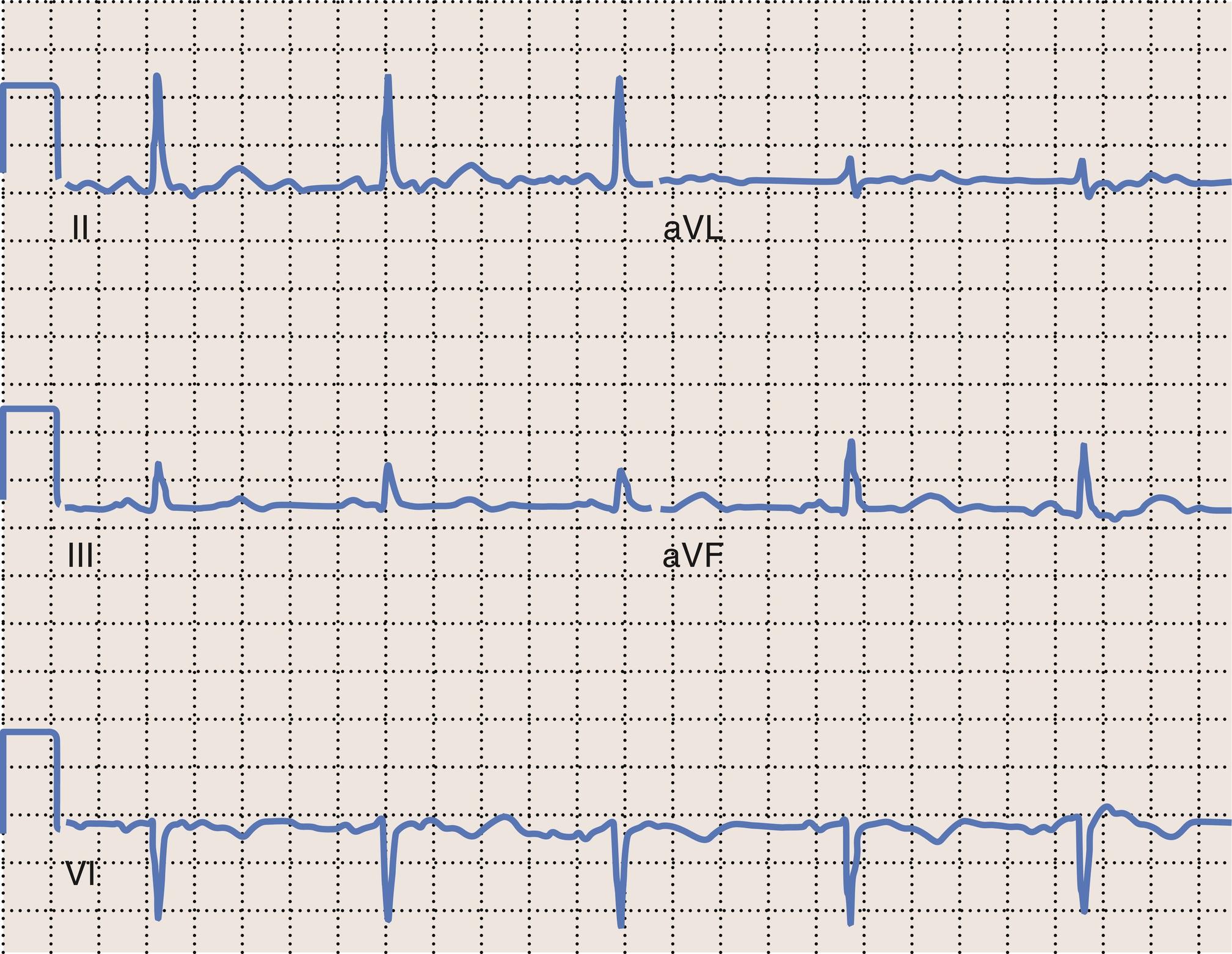 Fig. 15.4, Prolonged QT interval. The QT interval in this case is prolonged at a heart rate of 45 beats per minute. The rate-corrected QT (QTc) is equal to the QT interval/sqrt (RR interval).