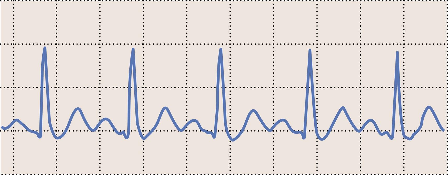 Fig. 15.6, Sinus tachycardia at a rate of approximately 150 beats per minute.