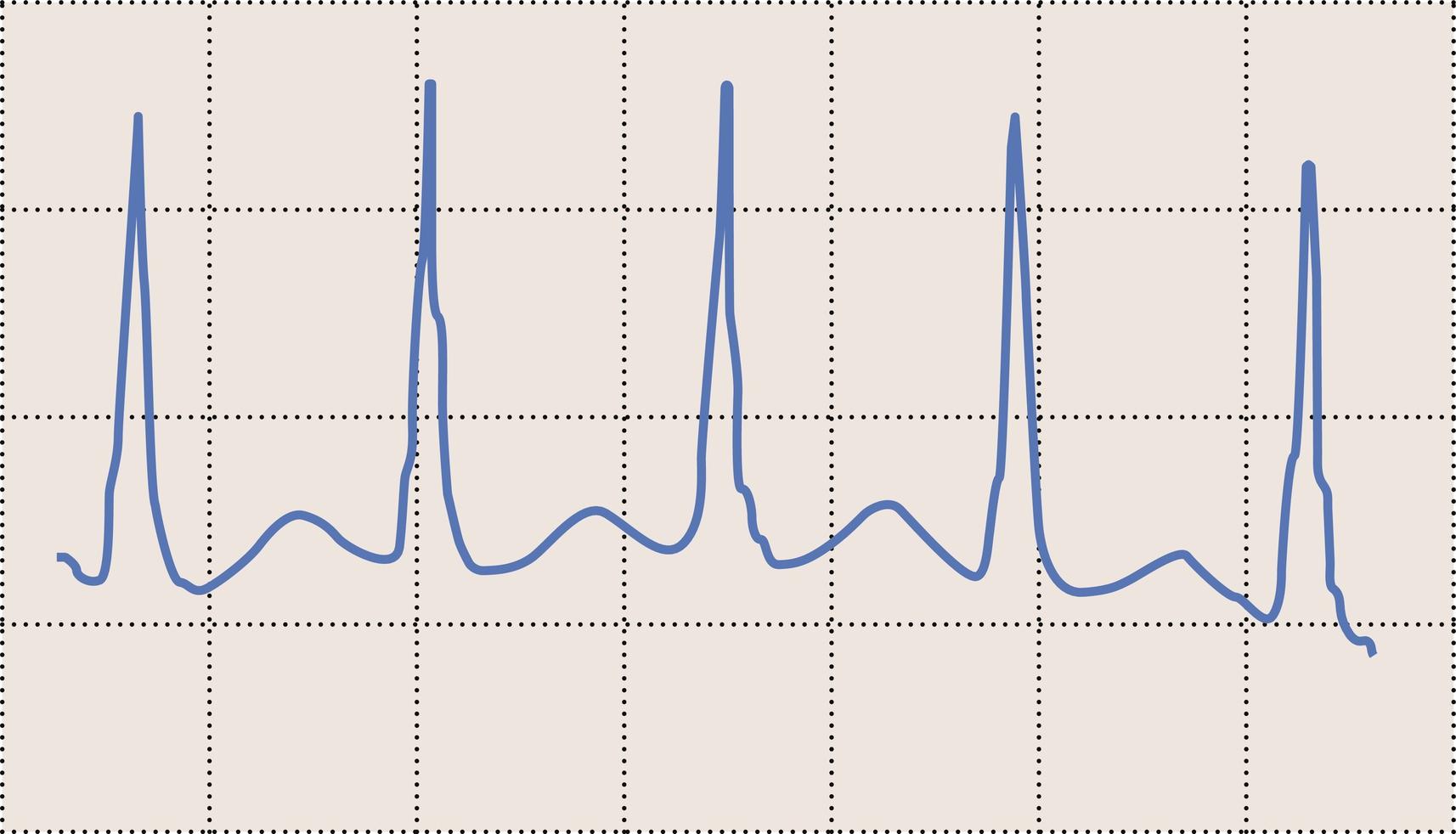 Fig. 15.7, Rhythm of atrioventricular nodal reentrant tachycardia.