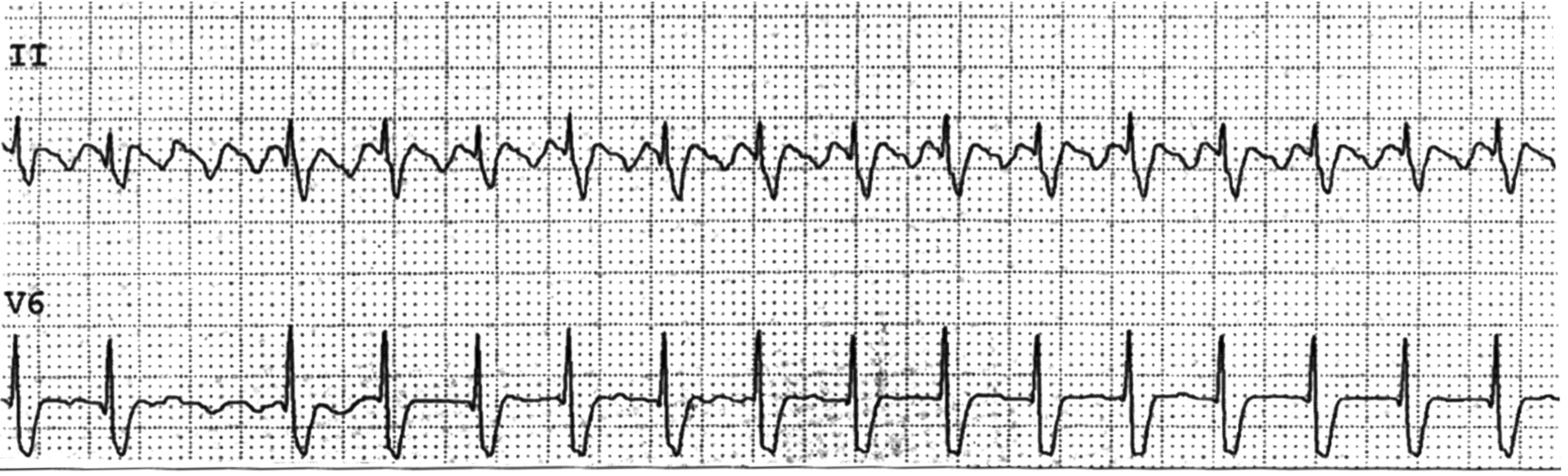 Fig. 15.8, Atrial flutter, 2:1 pattern.