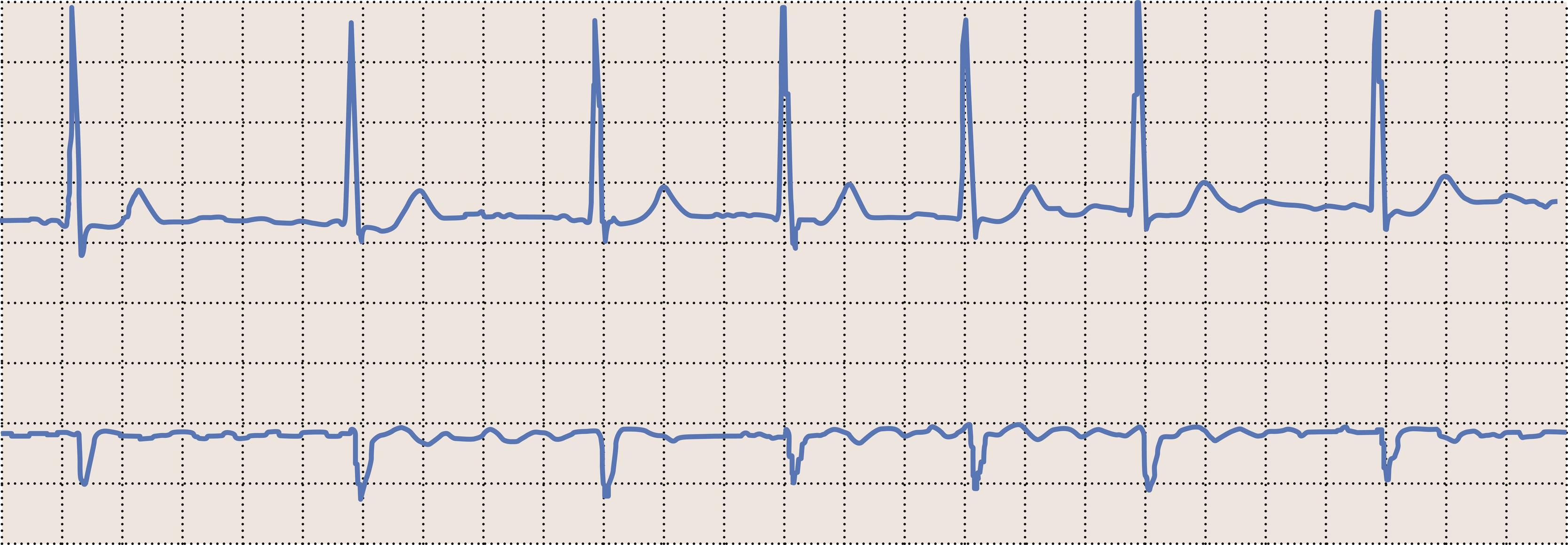 Fig. 15.9, Atrial fibrillation.