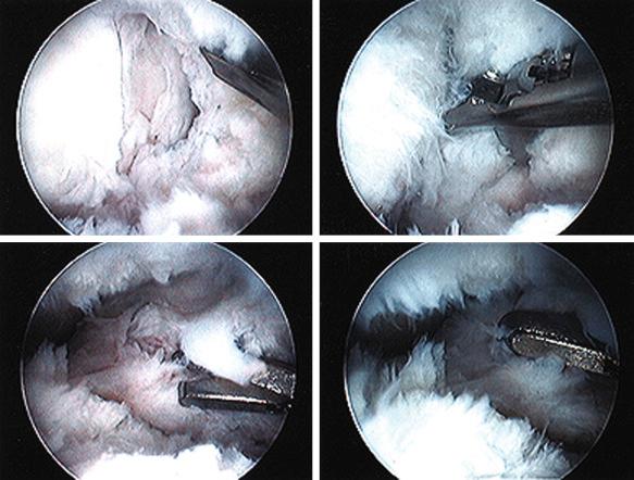 FIG 38-1, Proliferative formation of scar tissue requiring arthroscopic debridement and lysis of adhesions. A contracture of medial and lateral parapatellar soft tissues is shown, along with patella and trochlear cartilage deterioration.