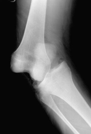 FIG 38-3, Acute knee dislocation leads to severe disruption of soft tissues, swelling, hemorrhage, and muscle damage always resulting in motion problems and risk of arthrofibrosis.