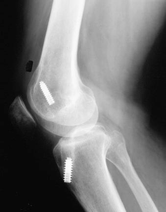 FIG 38-4, Lateral radiographs show excessive anterior placement of the femoral tunnel limiting knee flexion and the anterior tibial tunnel limiting knee extension. The graft failed as motion was regained postoperatively.