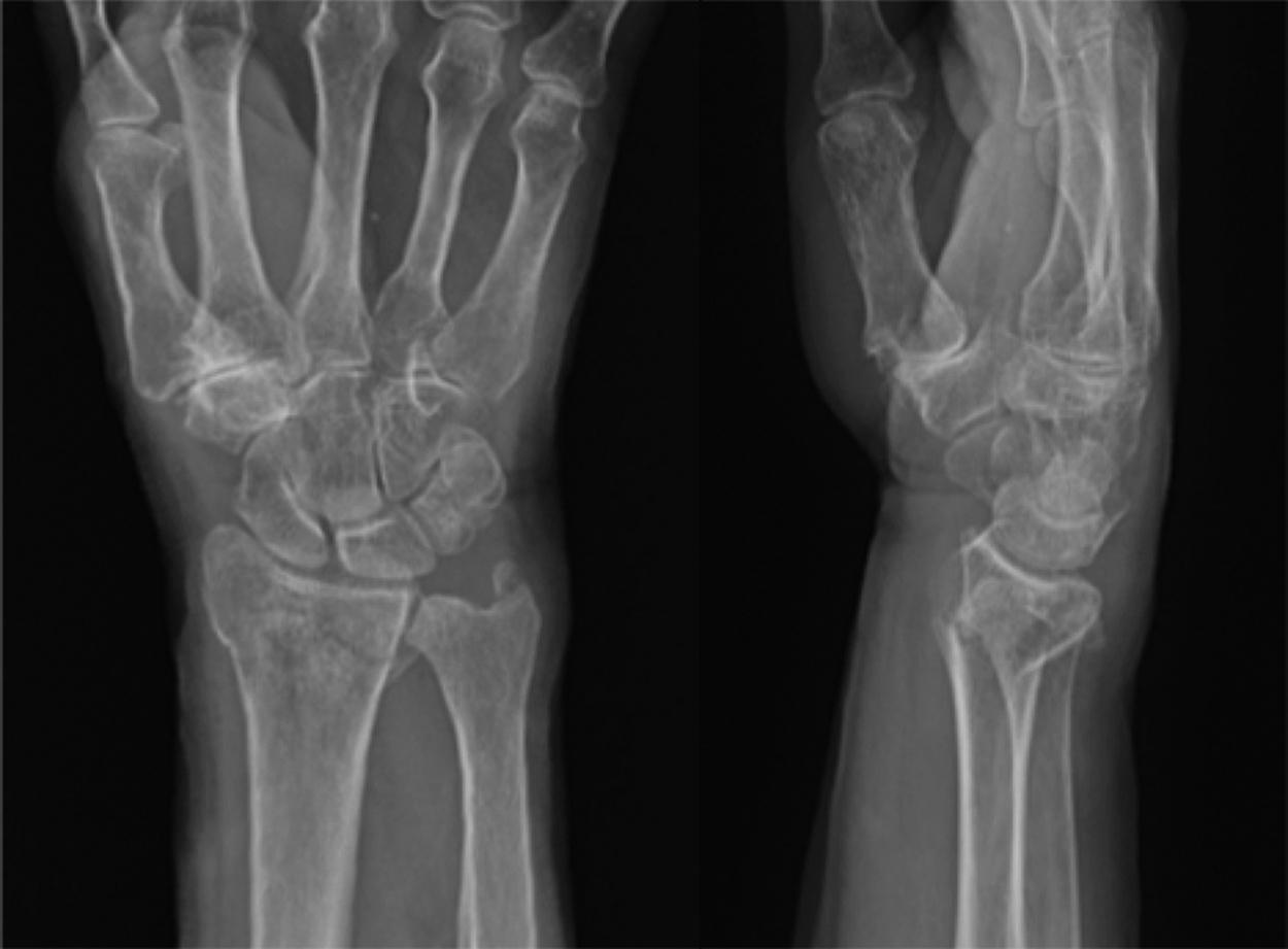 Fig. 2, Subsequent left distal radius fracture sustained from another ground level fall.