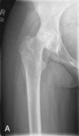 Fig. 83.1, (A) Preoperative right hip fusion anteroposterior (AP) hip radiograph of a 12-year-old female with a history of slipped capital femoral epiphysis with osteonecrosis and secondary advanced degenerative changes. (B) AP pelvis radiograph 5 years postfusion showing right hip arthrodesis done via an abductor-sparing approach (anterior approach with screw from within the pelvis across the hip joint into the femoral head). (C) True lateral right hip radiograph.